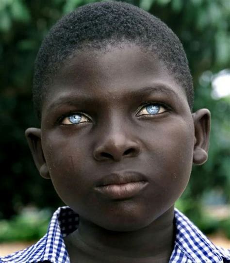 African Boy With Ocular Albinism People With Blue Eyes Black With