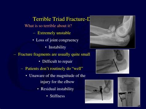 Ppt Surgical Approaches For “ Terrible Triad ” Fracture Dislocations