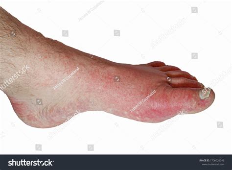 Gout Foot Male Foot Swollen Red Stock Photo 1706026246 Shutterstock