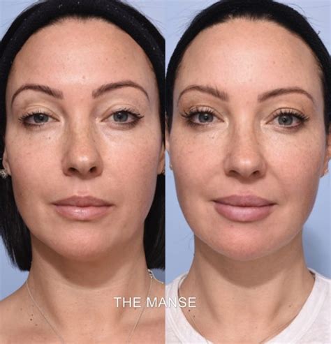 Temple Dermal Filler Before And After Images Sydney Clinic
