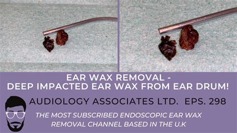 Deep Impacted Ear Wax Removal From Eardrum Ep 298 Youtube