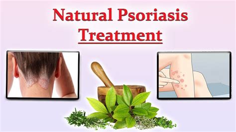 Natural Psoriasis Treatment Ayurvedic Treatment For Psoriasis Youtube