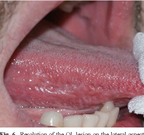 Figure 3 From Oral Leukoplakia Associated With Amalgam Restorations