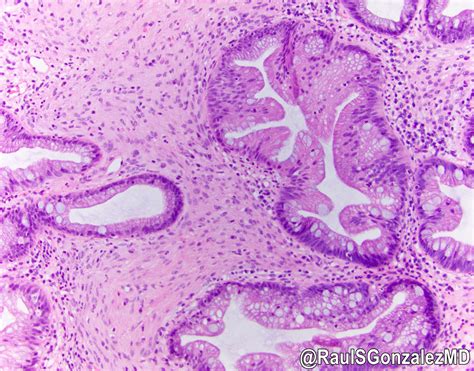 Pathology Outlines Sessile Serrated Adenoma