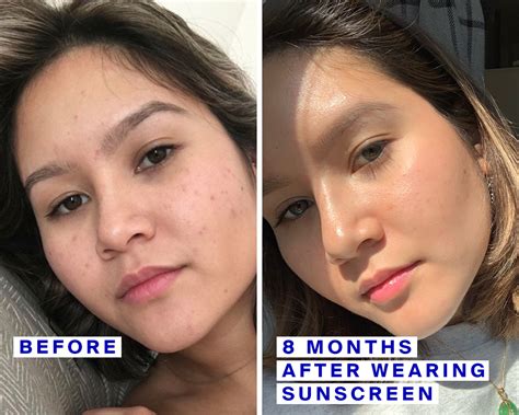 Aha and bha peels are one of the best modern treatments for spots and scars. Acne Scars and Sunscreen: 2 Stories About How SPF Helped ...