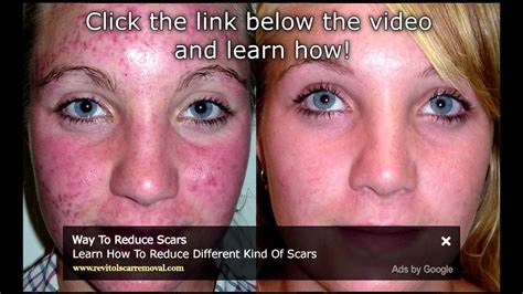 Watch How To Make Acne Scars Go Away Pimple Scars Youtube