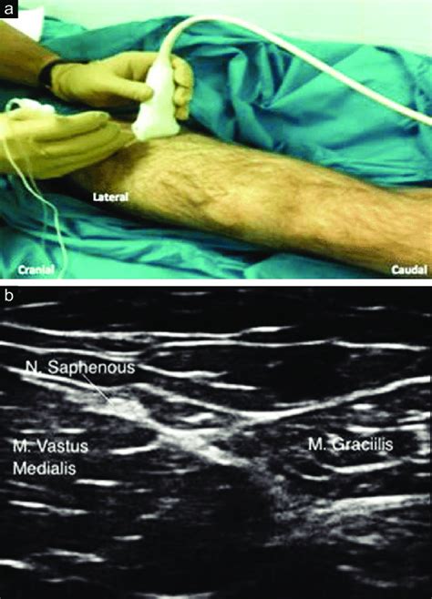 Take your time and walk your passenger through what you're doing. (a) Subsartorial approach to the saphenous nerve block, (b ...