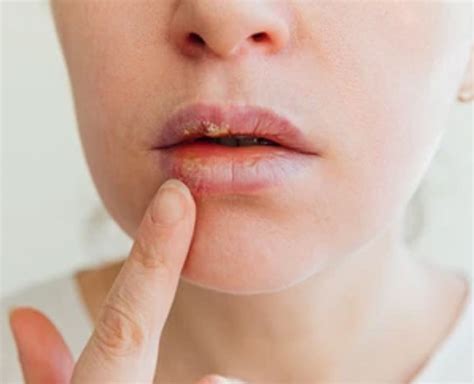How To Cure Lip Pimples Pimples On Lips Home Remedies Pimples On