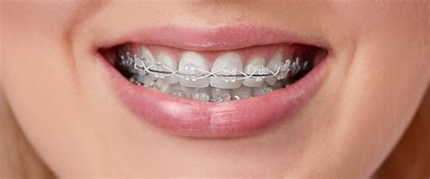 Clear Braces In Los Angeles Dentalville Panorama City