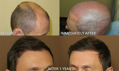 Przeszczep włosów Chicago zdjecia przed i po Przeszczep włosów Chicago