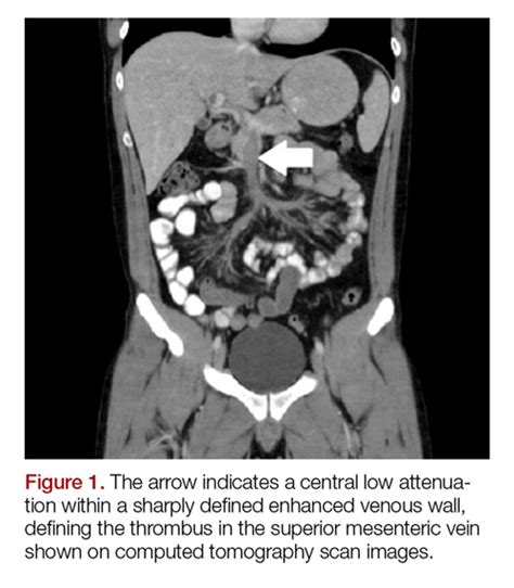 Acute Superior Mesenteric Venous Thrombosis In A Young Patient Without