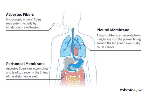 Causes Of Mesothelioma Asbestos Exposure And Risk Factors