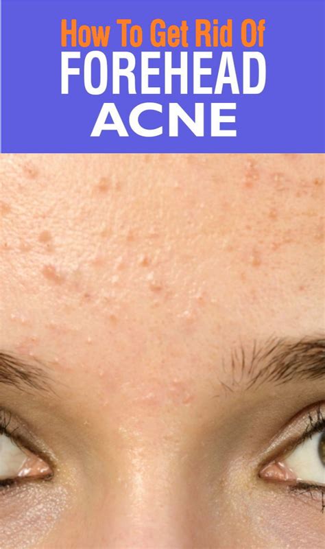 Forehead Acne Causes Treatment And Prevention Tips Wellness Magazine