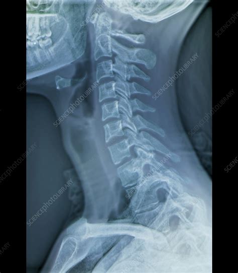 Maybe you would like to learn more about one of these? Normal neck, X-ray - Stock Image - F003/3499 - Science Photo Library