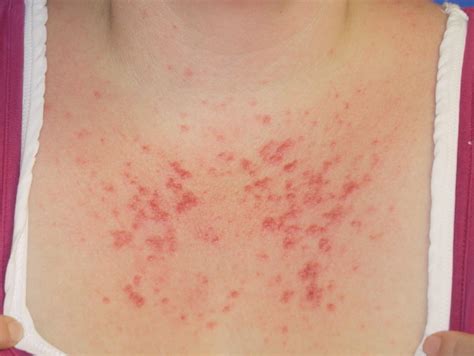 Severe Sun Allergy Treated Successfully With Homeopathy Dr Thind