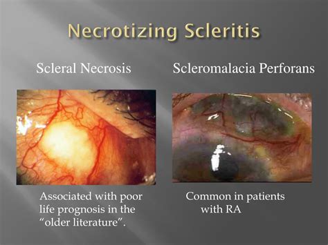 Ppt Scleritis Diagnosis Systemic Associations And Management