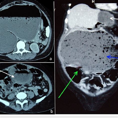 Cect Showing Multiple Hydatid Cyst In The A Liver And B Omentum