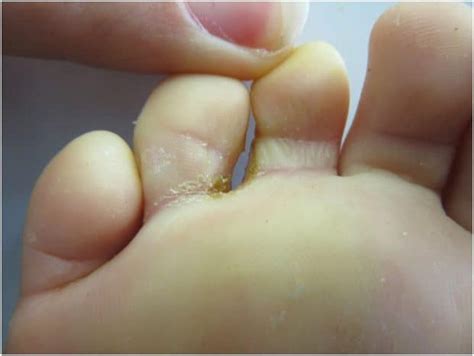 Penyakit kaki makan air disebabkan kulat. Punca Gatal Celah Kaki, Angkara Ulat Air! Ini Cara ...