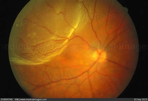 Stock Image Retinal Photograph Fundus View Showing Retinal Detachment
