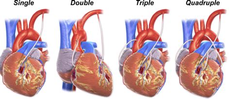 What Is A Coronary Artery Bypass Graft Learn More Online