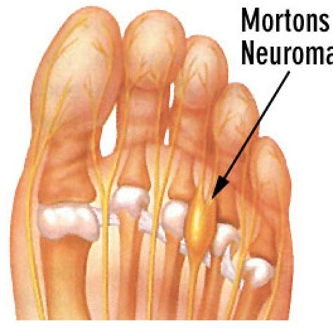 Mortons Neuroma The Podiatry Group