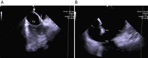 4 Dimensional Intracardiac Echocardiography In Transcatheter Tricuspid