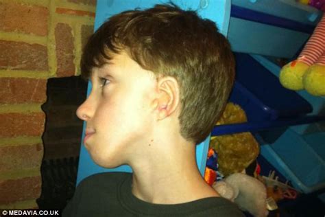 Awesome Stuff Boy Born Without An Ear Has One Built From One Of His