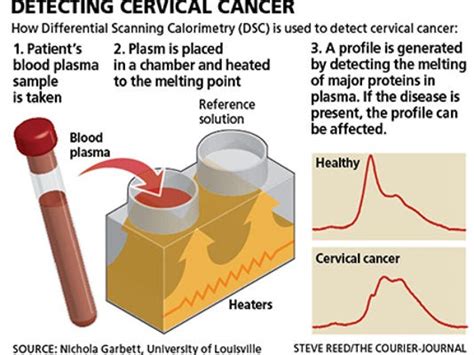 Blood tests that pick up these clues are being developed for a variety of. University of Louisville study | New blood test can ID ...