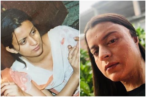 Kanganas Sister Rangoli Shares Horrific Details Of Acid Attack