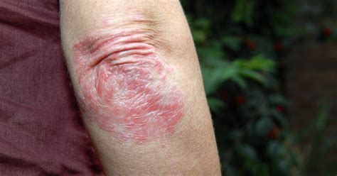 Ra Rash On Arms Cenfesse