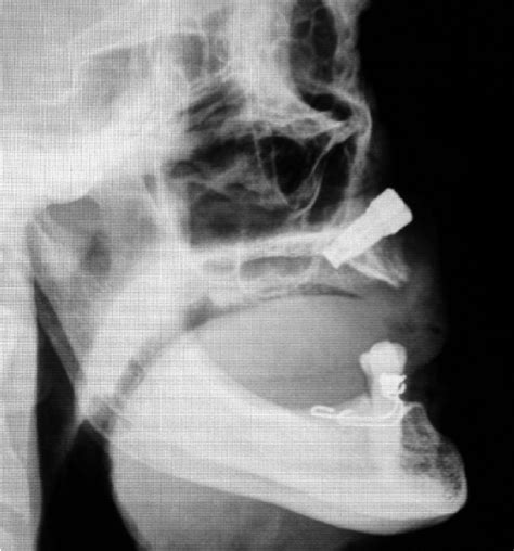 Lateral Skull Radiograph Showing The Implant Fixtures Placed Into The