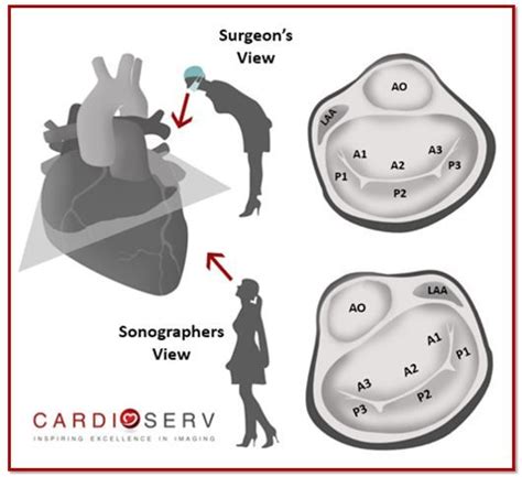 Finally Mitral Valve Orientation Explained Cardiac Anatomy Medical