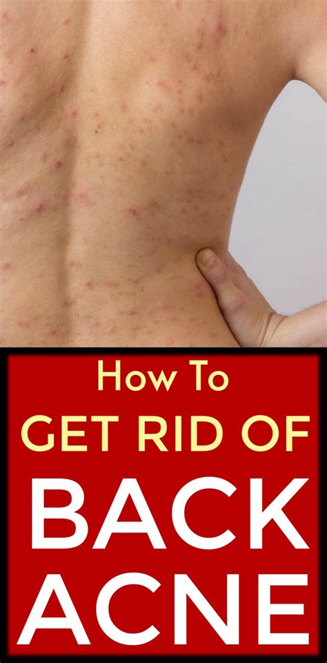 How To Get Rid Of Back Acne Easy Home Remedies Backacne Acne