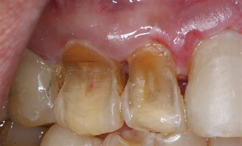 What Is The Difference Between Dental Attrition Abfraction Erosion