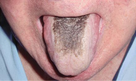 He played hockey and baseball as a youth and was on his college's baseball squad. Black, Hairy Tongue: Signs, Symptoms, Causes and Treatment