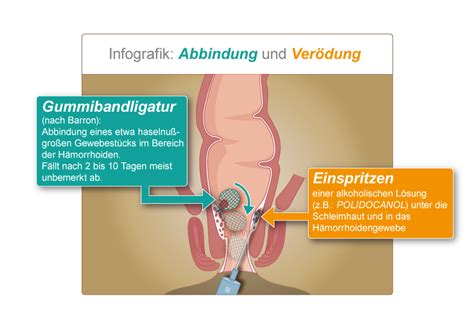 Innere hämorrhoiden symptome und anzeichen von erkrankung. Verödung von Hämorrhoiden - End- und Dickdarmpraxis ...