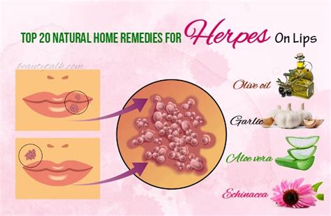 Have been exposed to this virus. Top 23 Ways On How To Get Rid Of Cystic Acne Naturally ...