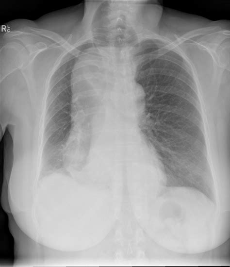 Chest X Ray And Chest Plain Computed Tomography A Chest Radiograph On