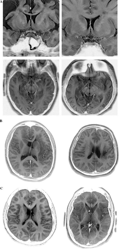 Clinical Application Of High And Ultra High Field Mri Brain And