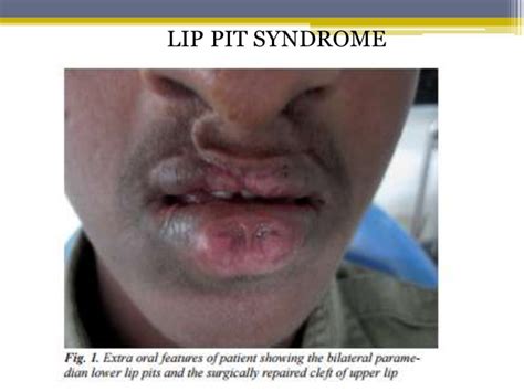 Disorders Of Lip