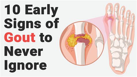 10 Early Signs Of Gout To Never Ignore Signs Of Gout Gout Foods