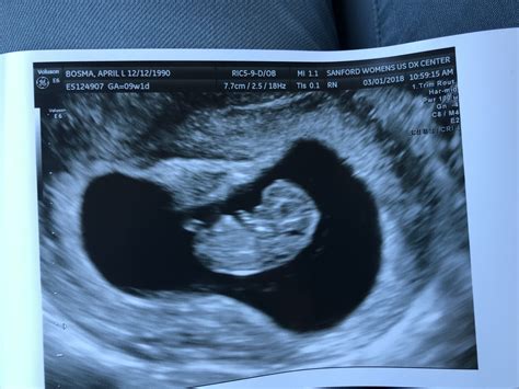 Identical Twins Ultrasound 7 Weeks