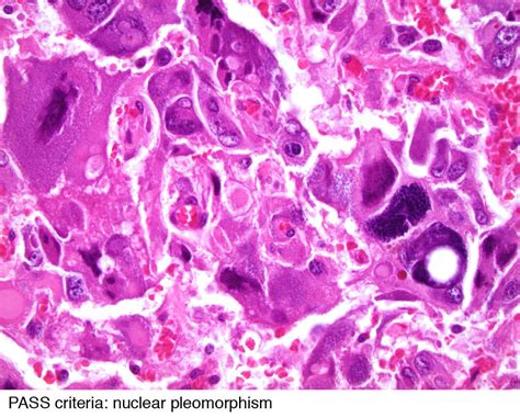Pathology Outlines Features To Report Pheochromocytoma Paraganglioma