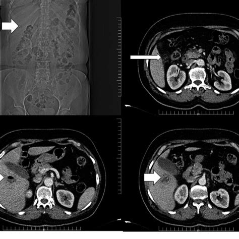 Ct Scan Showing The Abscess Formation In Segment V Of The Liver With An