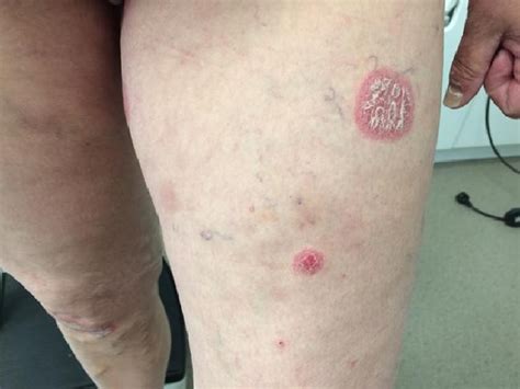 Psoriasis Associated Koebner Phenomenon After Withdrawal Of