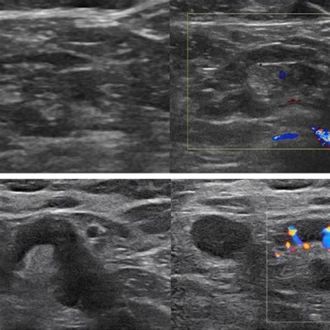 A Biopsy Proven Metastatic Lymph Node In A 72 Year Old Female Patient