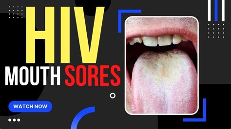 When Do Hiv Mouth Sores Appear YouTube