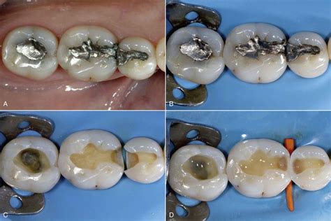 9 Direct Composite Restorations Pocket Dentistry