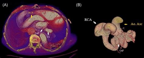 A Ct Volume Rendering Reconstruction Axial View Showed Giant Rca And