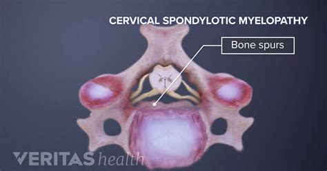 Cervical Myelopathy Definition Back Pain And Neck Pain Medical Glossary